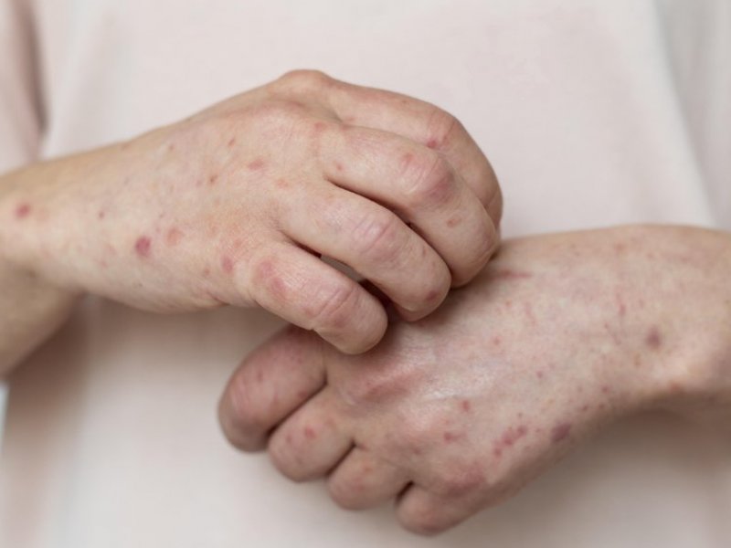 Bahia investiga novo caso suspeito de Mpox