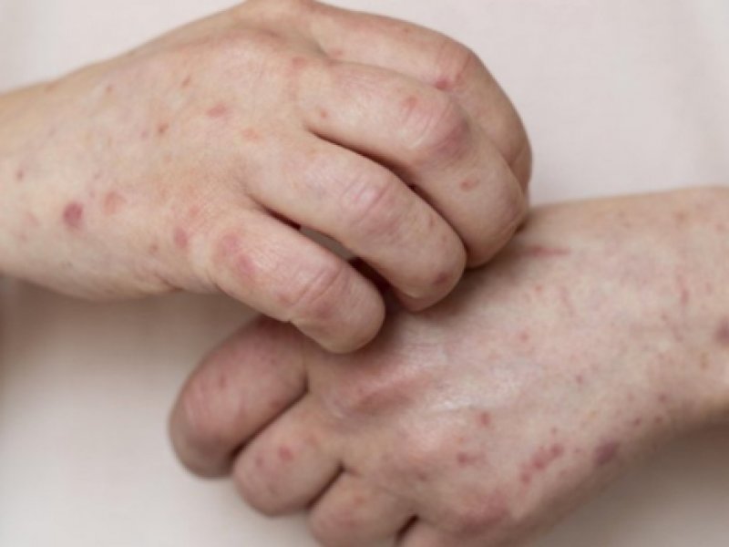 Mpox registra 149 casos em 13 estados; veja situação da Bahia