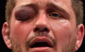Lutador fica desfigurado após ser atingido no olho durante evento do UFC