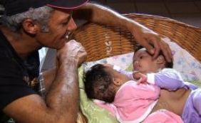 Separada, siamesa de Itamaraju apresenta melhora; estado ainda é grave