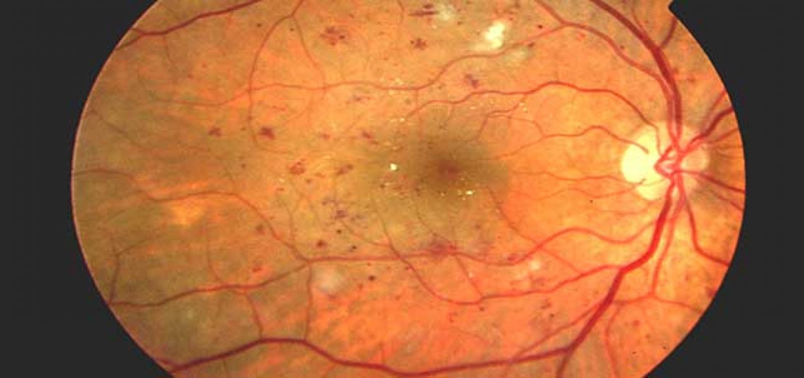 CAPV Optometria - Muitas doenças afetam a região dos olhos