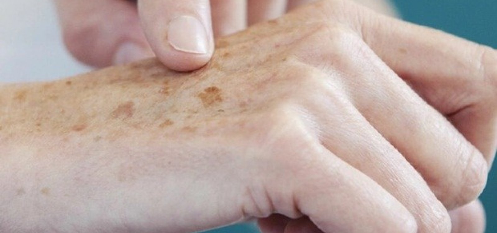 Cientistas rejuvenescem pele de mulher em 30 anos, diz estudo