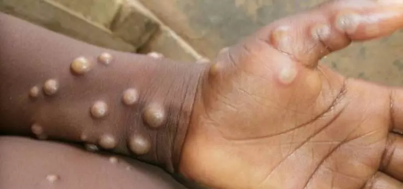 OMS confirma registro de 92 casos de varíola de macaco em 12 países