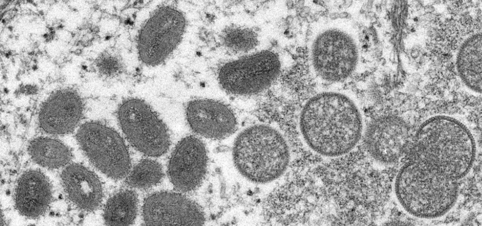 Argentina tem primeiro caso confirmado de varíola dos macacos na América Latina