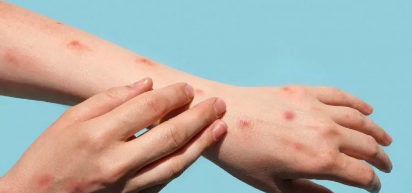 SP confirma segundo caso de varíola dos macacos