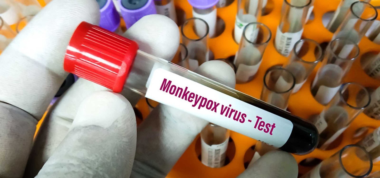 OMS declara varíola dos macacos emergência internacional de saúde