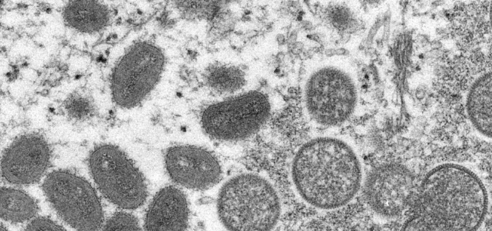 Bahia tem mais dois casos confirmados de varíola dos macacos 