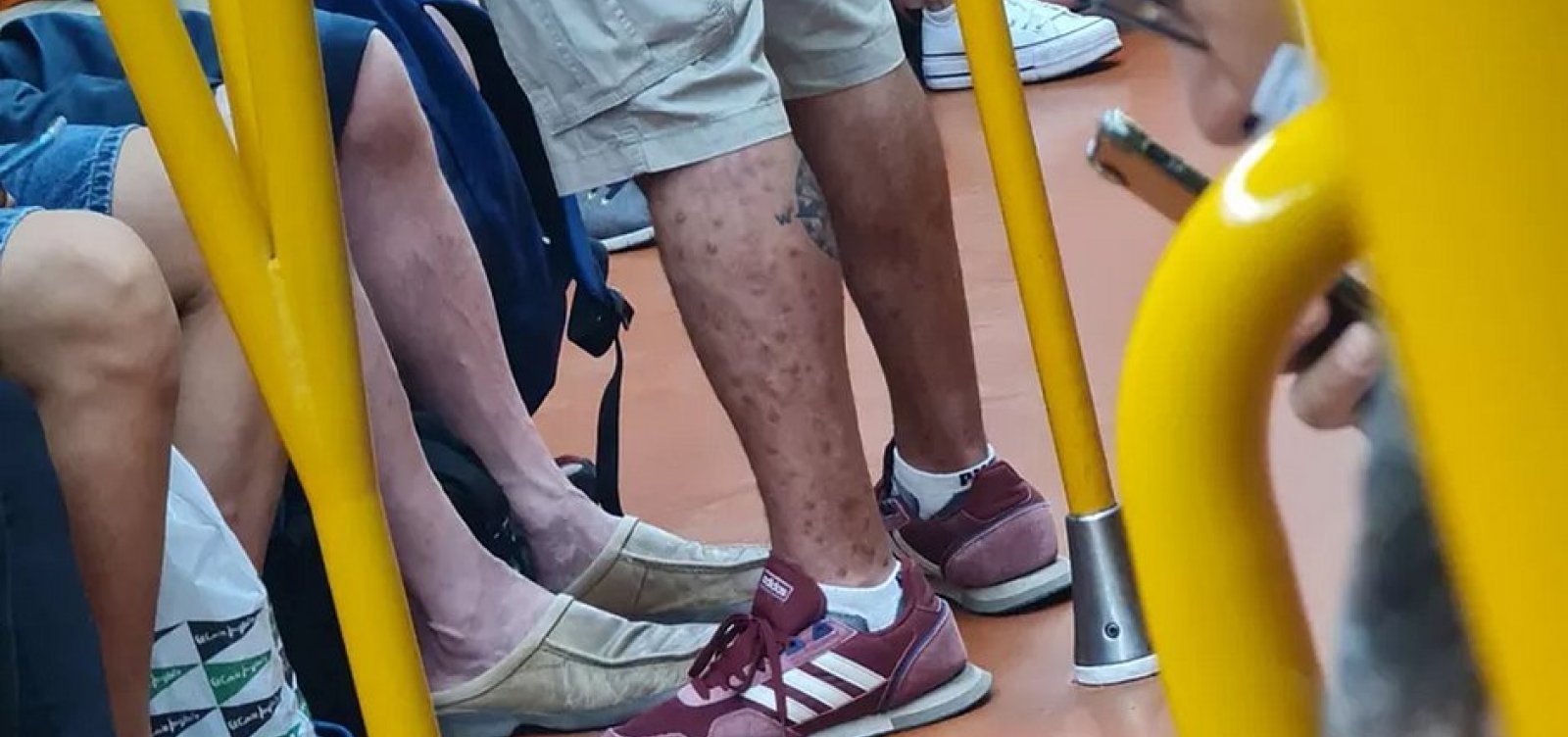 Médico flagra homem infectado com varíola dos macacos em metrô