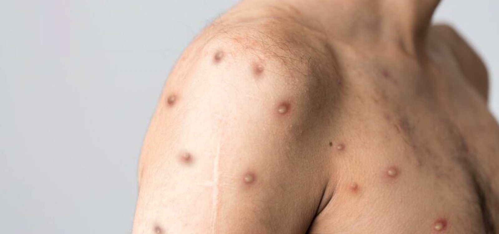 Mais dois casos de varíola dos macacos são confirmados na Bahia