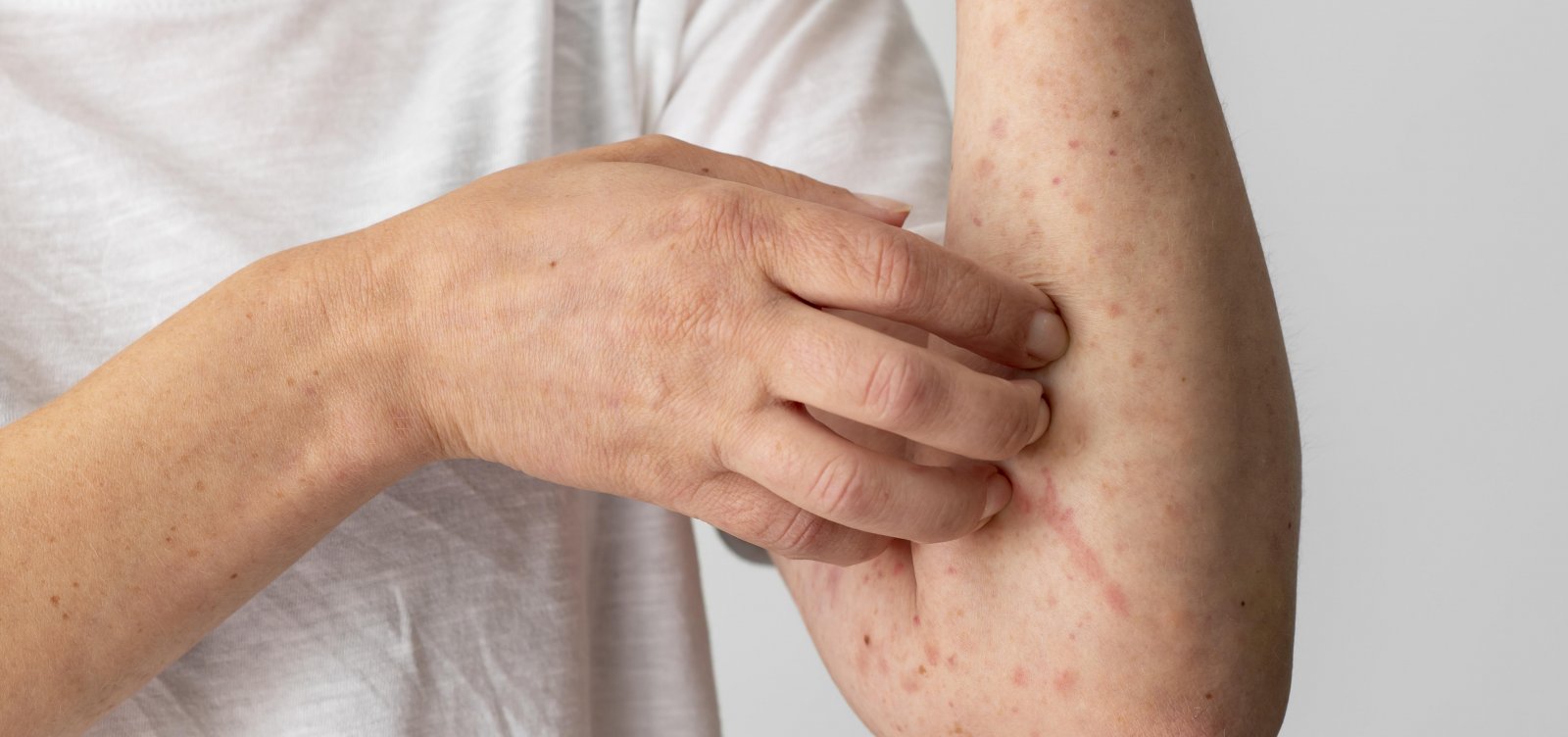 Anvisa aprova importa&ccedil;&atilde;o de vacina e antiviral contra var&iacute;ola dos macacos