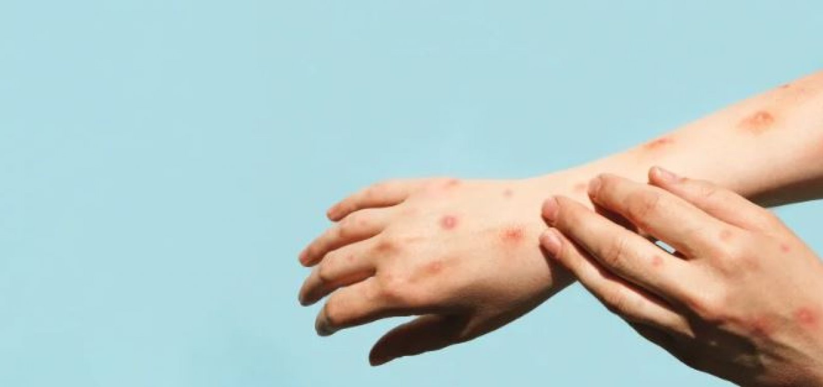 Bahia chega a 45 casos confirmados da var&iacute;ola dos macacos