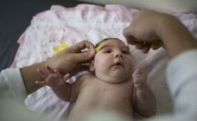 Microcefalia: sobe para 775 o número de casos suspeitos na Bahia