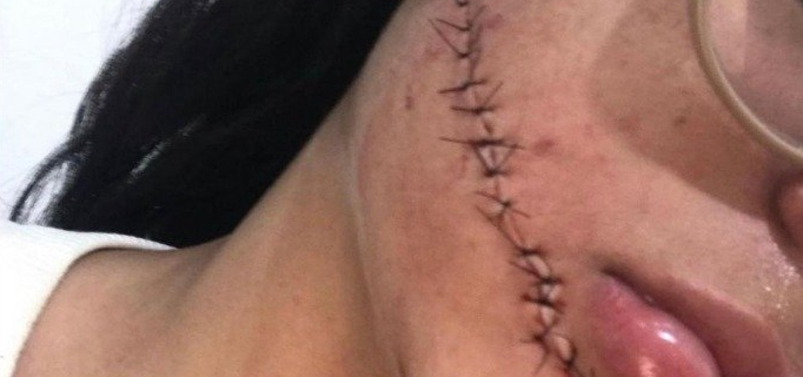 Jovem esfaqueada em ônibus durante viagem a Salvador leva 18 pontos 