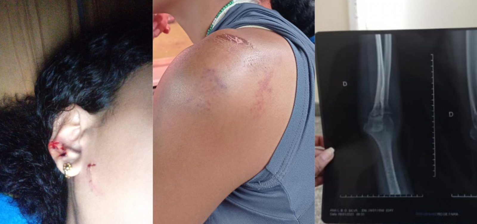 Campanha arrecada ajuda para mulher internada após ter braço quebrado por ex em Salvador