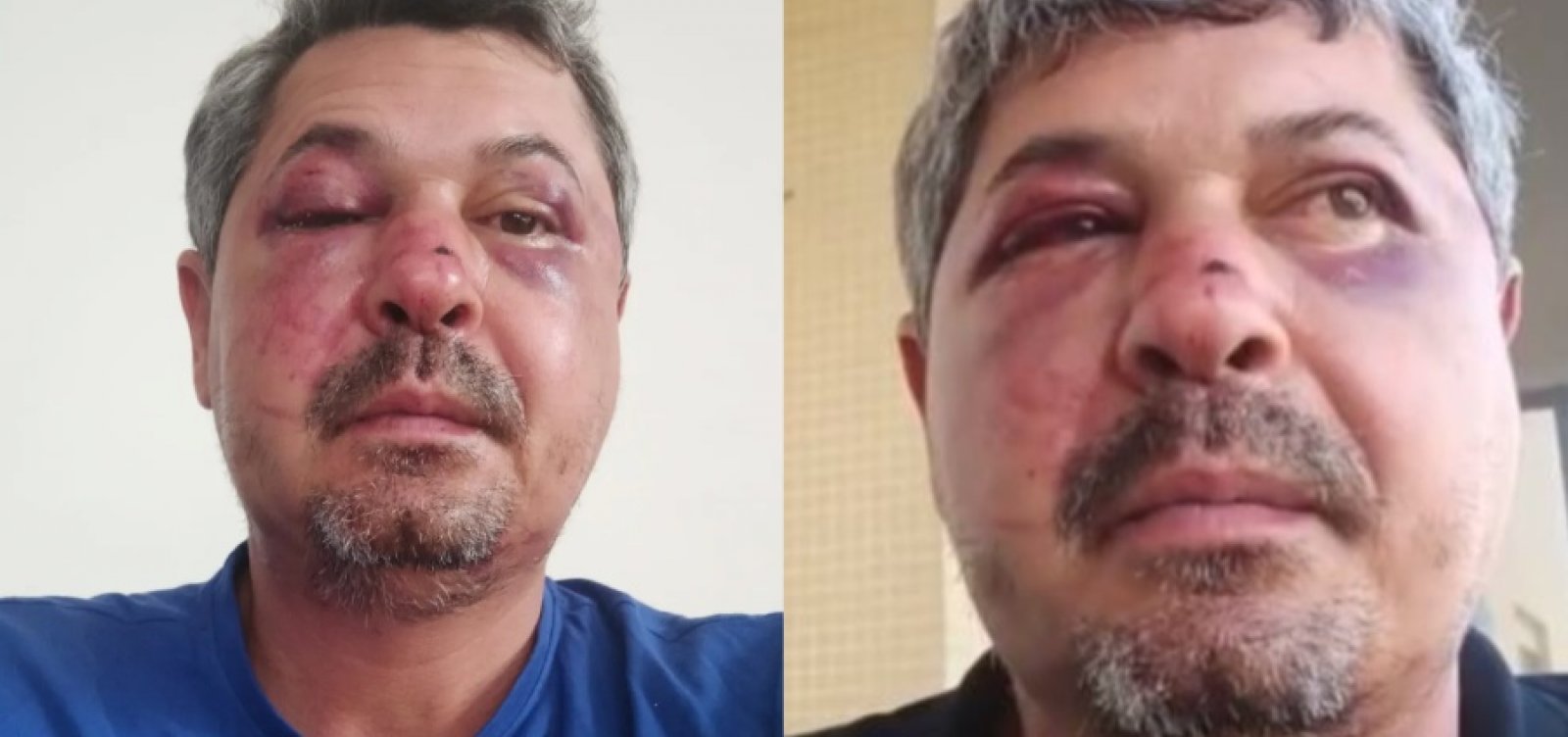 Brasileiro é espancado em ataque xenofóbico em Portugal: "Chutou minha cara e minhas costelas"
