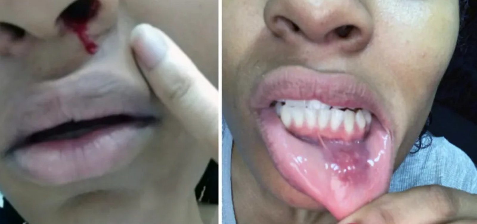 Patrícia Ramos divulga ferimentos de suposta briga com o ex-marido