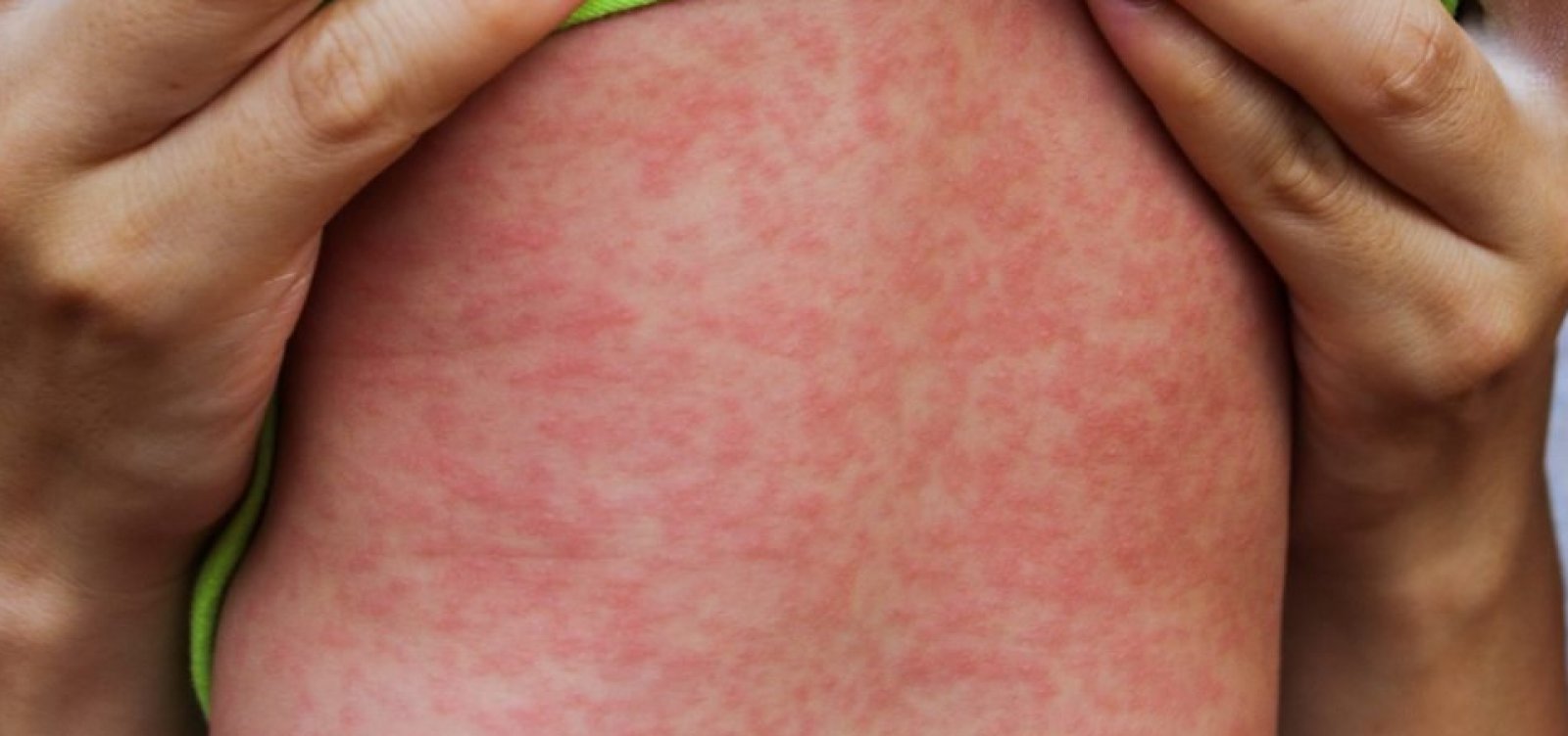 OMS volta a alertar sobre aumento de casos de sarampo no mundo