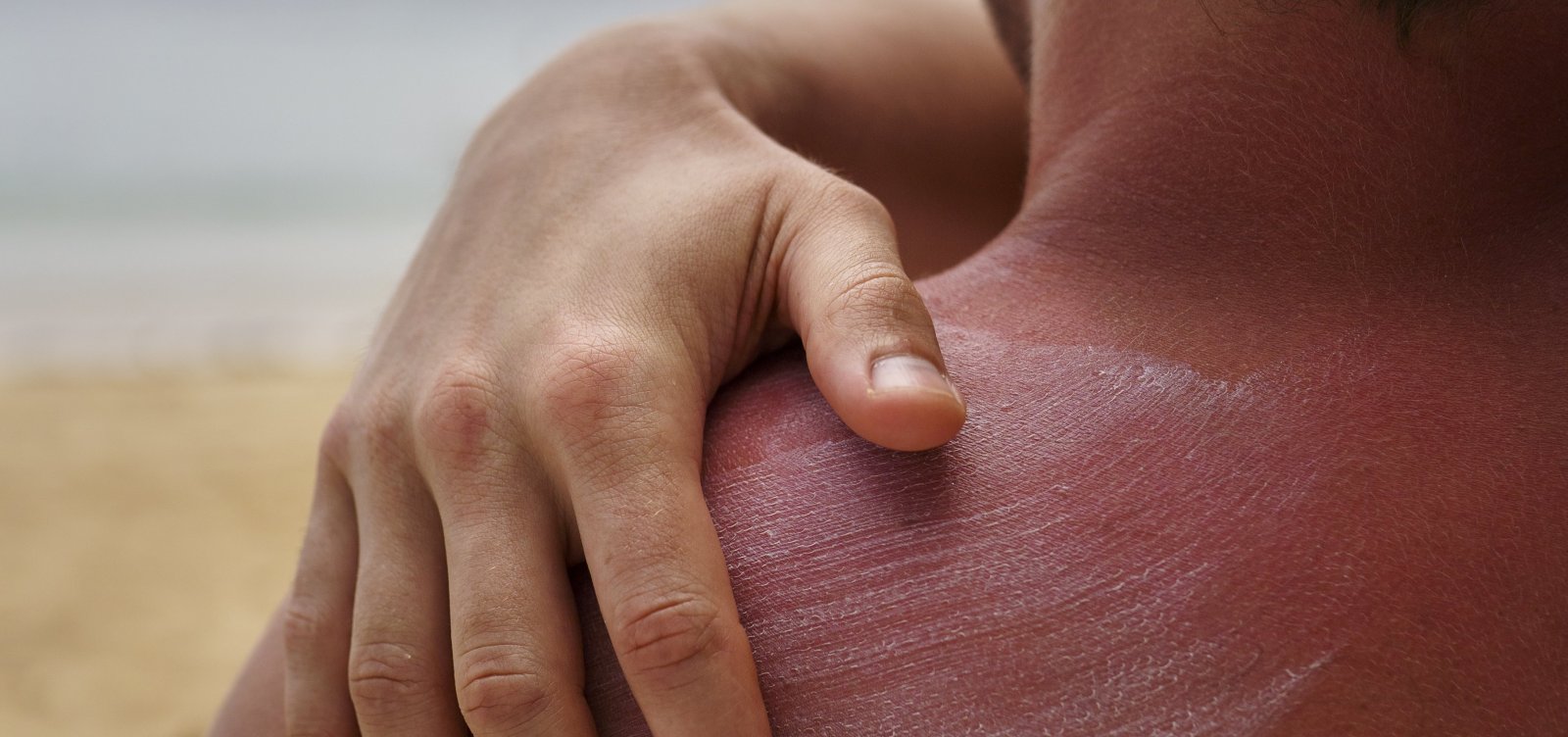 Exposição aos raios UV é responsável por 80% dos casos de melanoma cutâneo