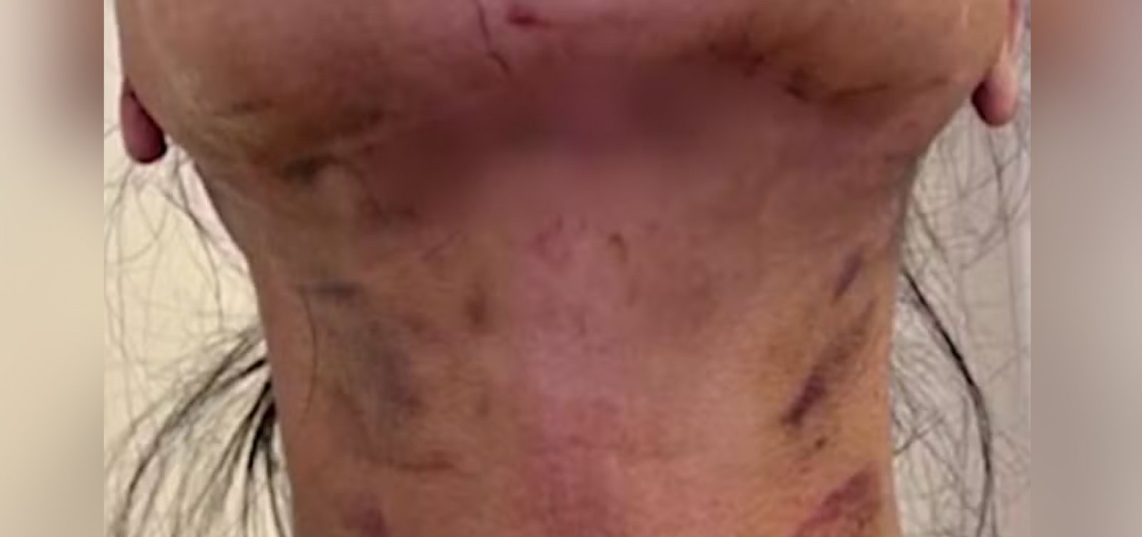 MP-BA denuncia dentista por complicações em "lipo de papada" em pacientes