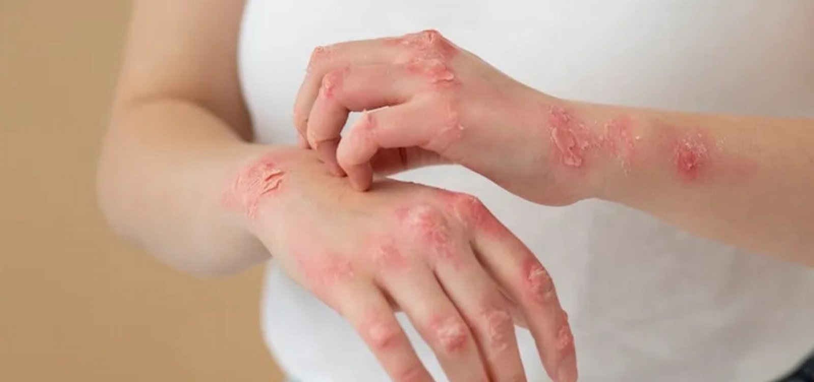 Comprimido desenvolvido com inteligência artificial é sucesso contra psoríase 