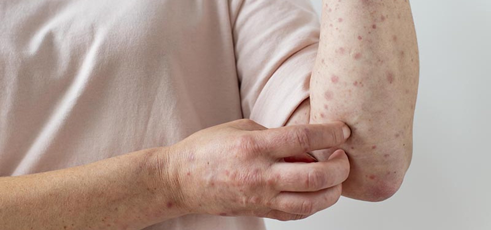 São Paulo confirma segundo caso de Mpox; saiba como se prevenir