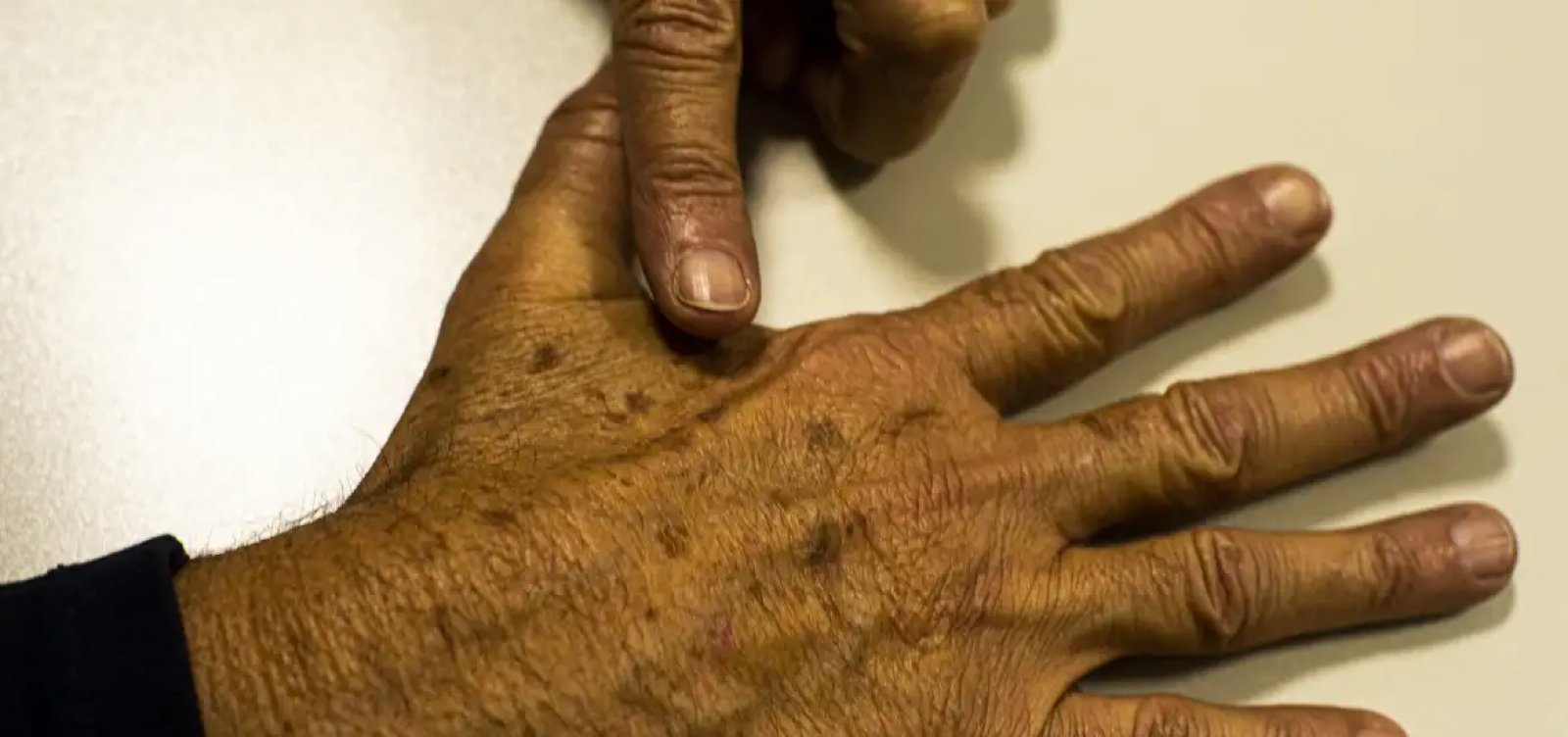 Casos de câncer de pele saltam de 4 mil para mais de 72 mil em 10 anos no Brasil