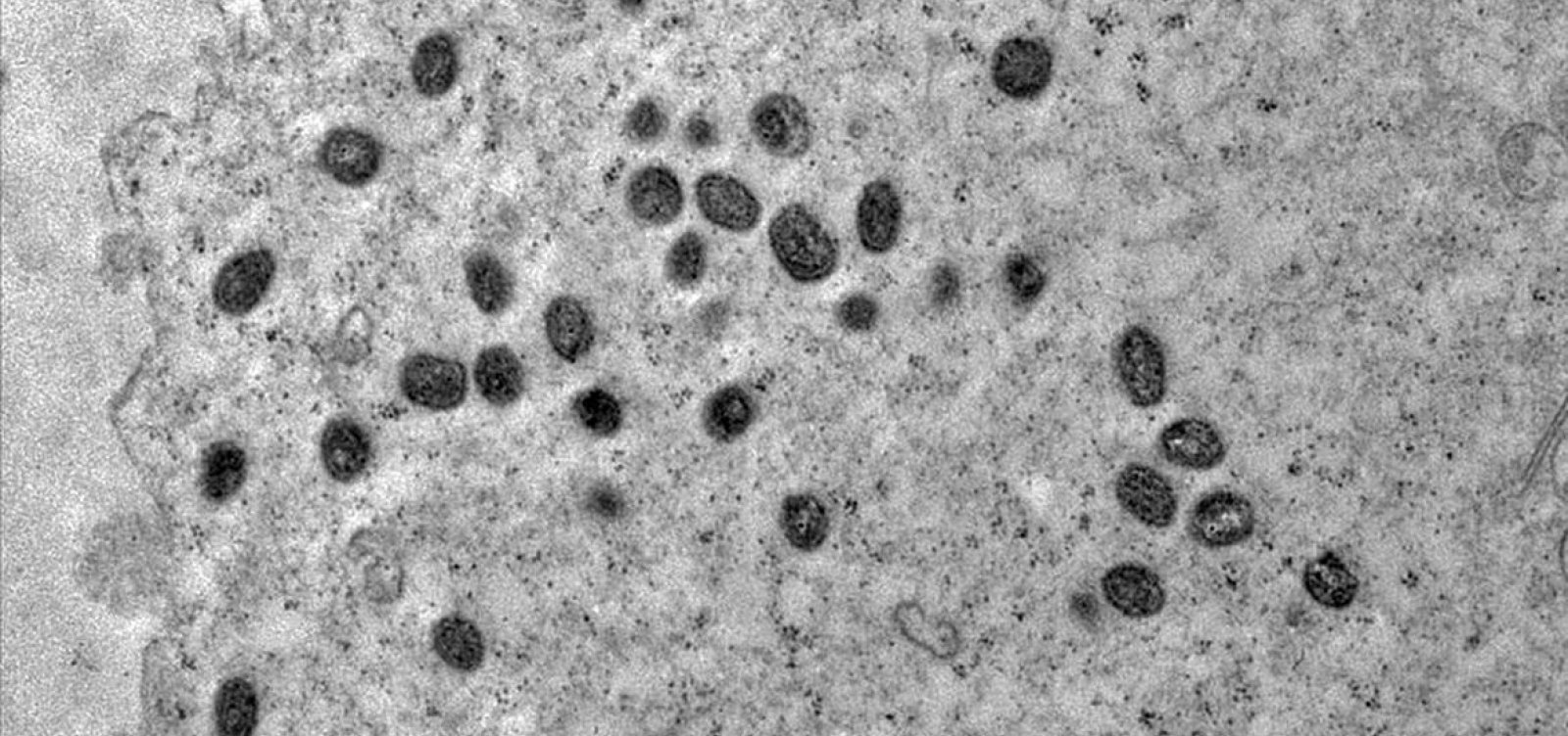 Nova variante de Mpox é identifica, alerta OMS