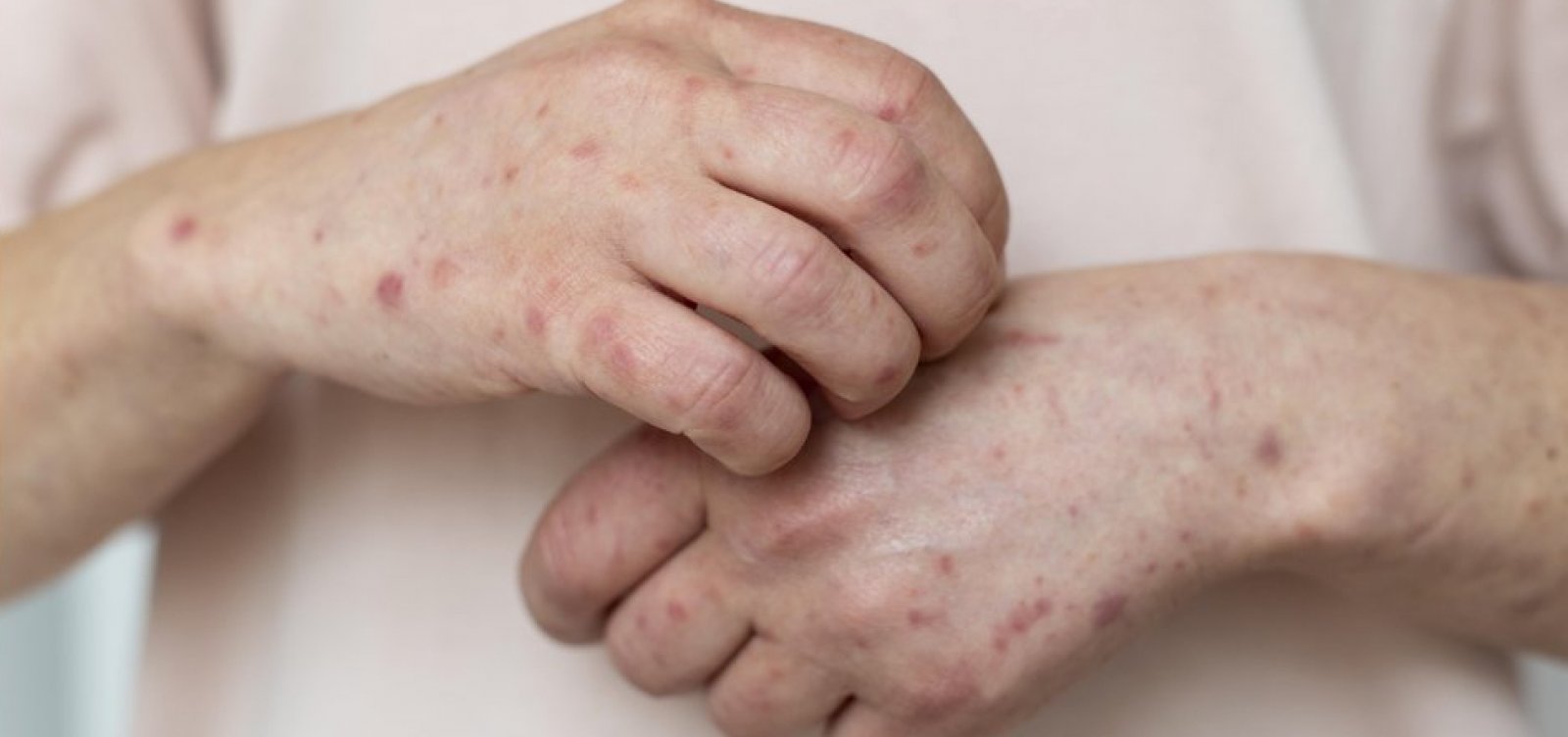 Bahia investiga novo caso suspeito de Mpox