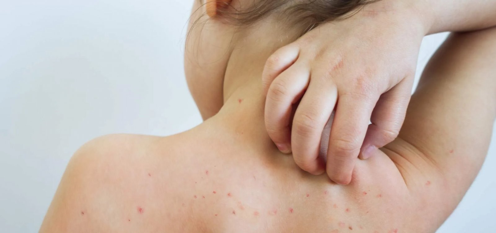 Sesab realiza estratégia de vigilância para detecção de sarampo e rubéola