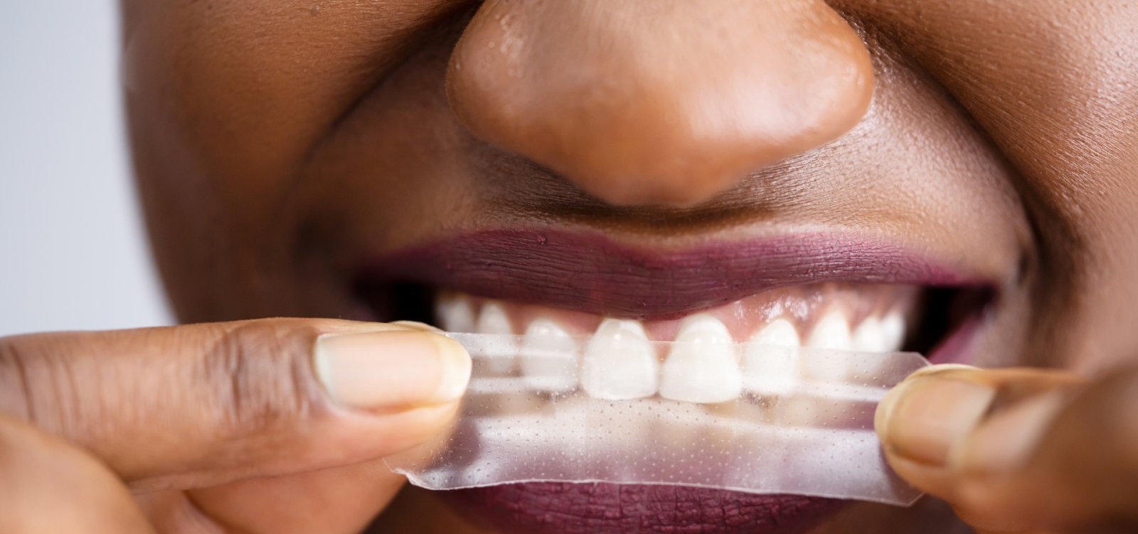 Anvisa manda recolher fitas de clareamento dental; entenda motivo