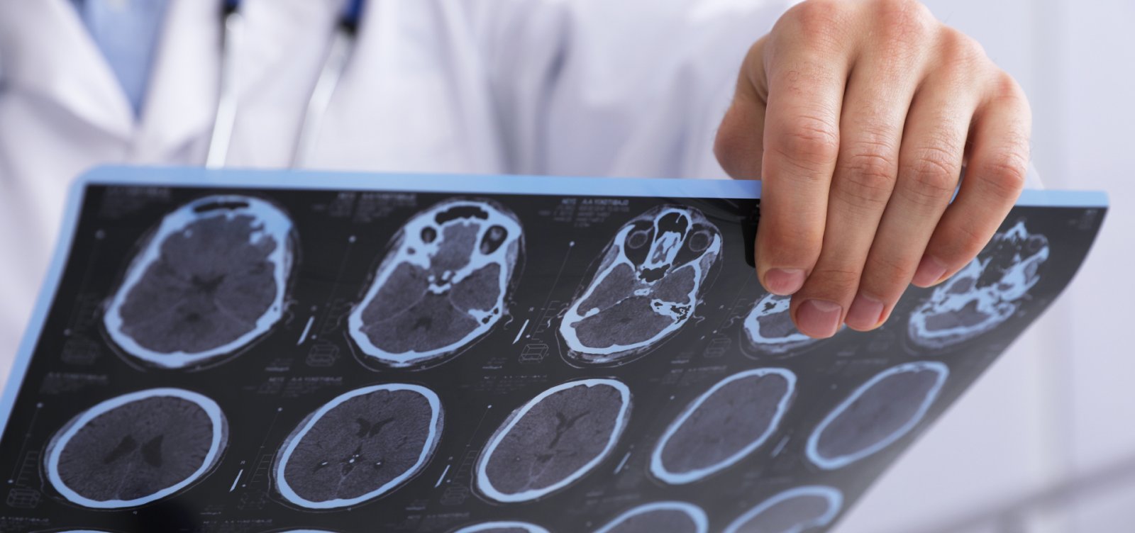 Anvisa aprova novo tratamento para Esclerose múltipla; confira medicamento