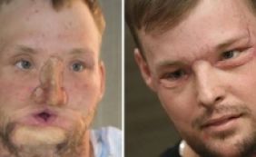 Americano recebe transplante de rosto e volta a usar espelho após 10 anos
