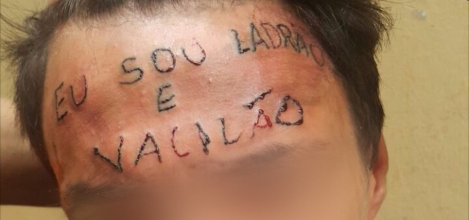 Menino que teve a testa tatuada faz primeira sessão de remoção em São Paulo  