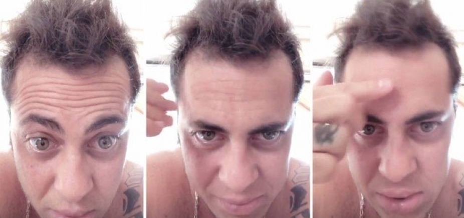 Thammy Miranda sofre com careca e namorada brinca: ʹFaz implanteʹ