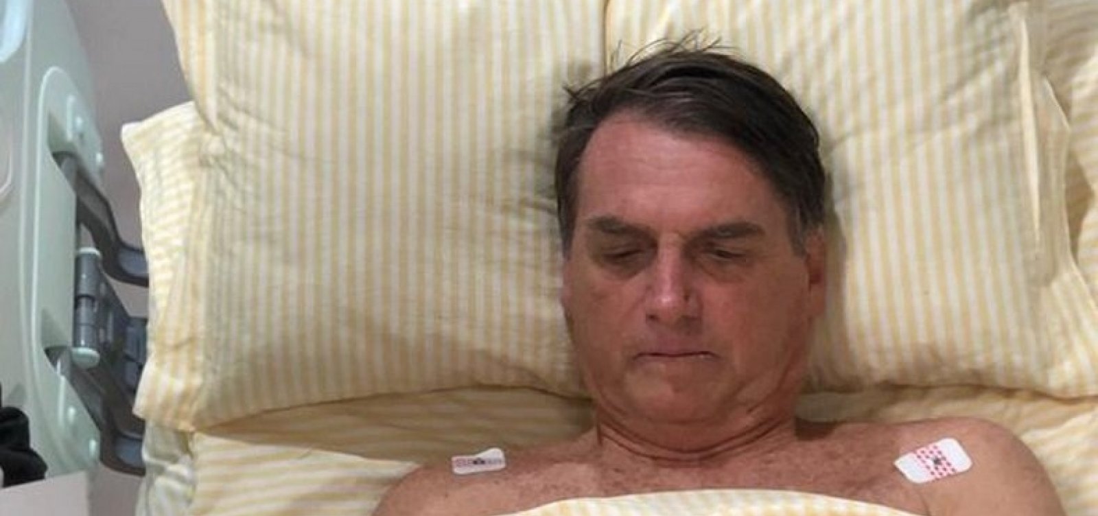 Náuseas e vômitos de Bolsonaro foram em decorrência de paralisia no intestino