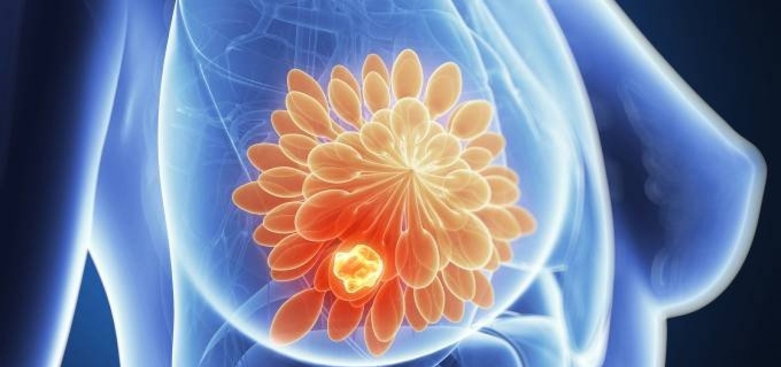 Anvisa aprova nova medicação para tratamento do câncer de mama