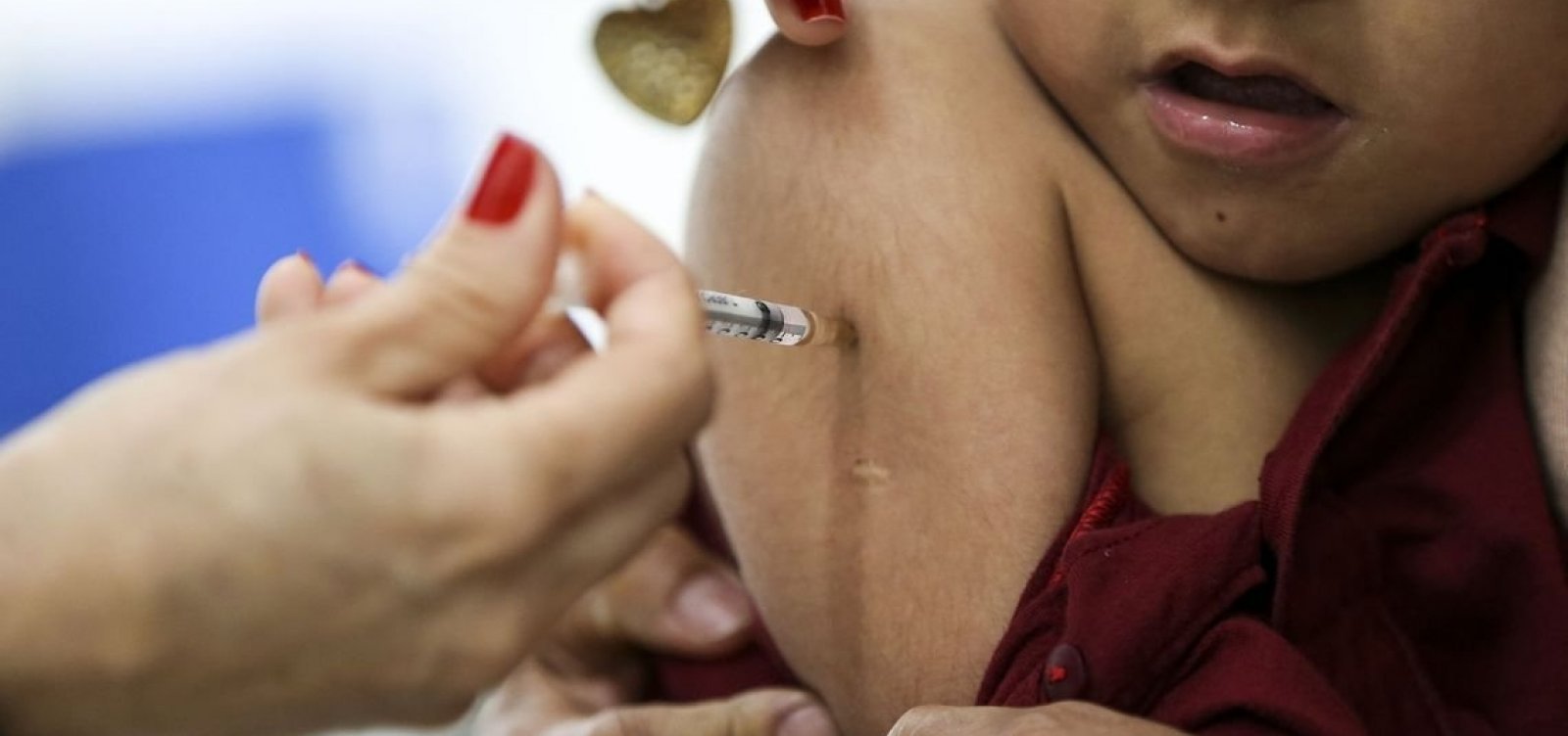 Dezesseis estados brasileiros estão em surto ativo de sarampo