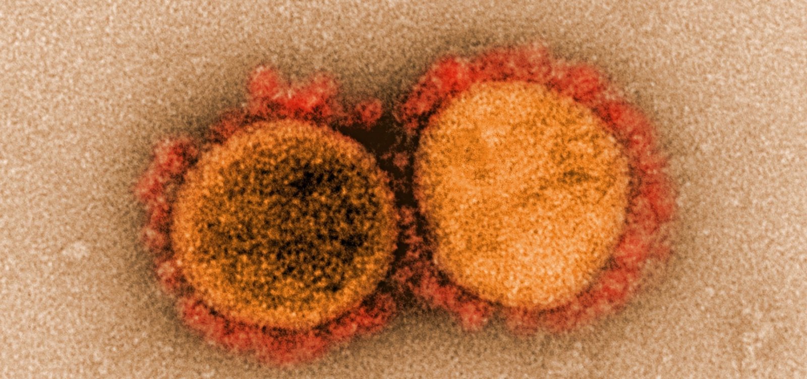 Bairros Caixa D’agua e Cardeal registram primeiros casos de coronavírus